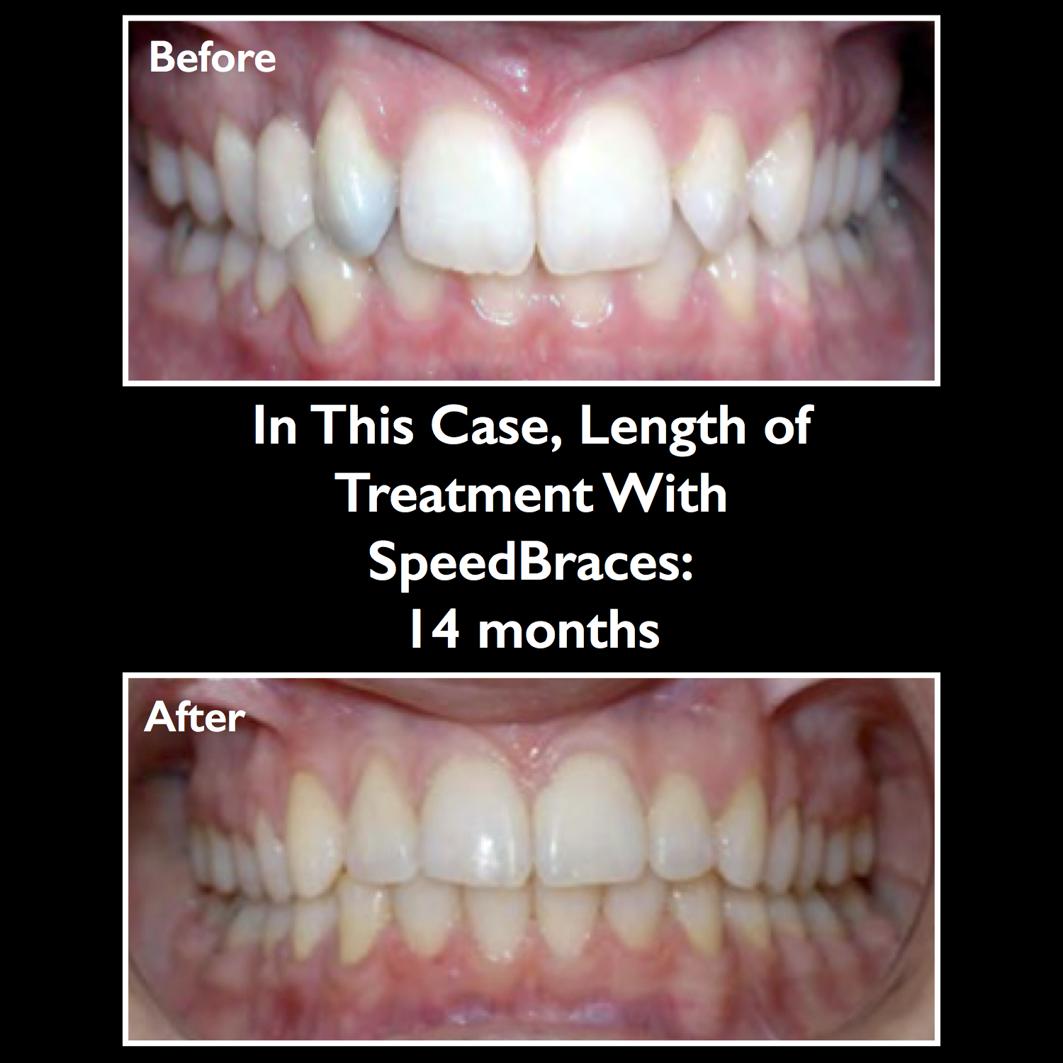 Speed Braces « The Tooth Mover