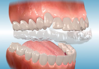 How elastics / rubber bands move teeth (time lapse) - Braces